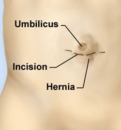 Hernia setback to recovery plans